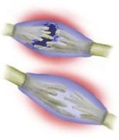 Nerve Injury Image